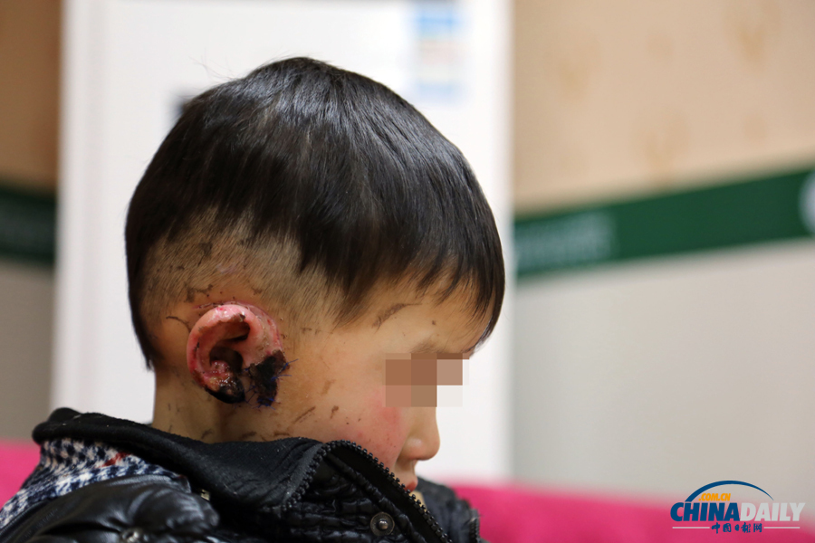 6歲男童慘遭嬸嬸割耳續(xù)：有醫(yī)院免費為他造左耳