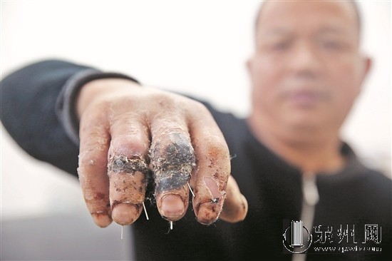 患者投訴醫(yī)院中指無名指錯接 醫(yī)院：要等鑒定結(jié)果