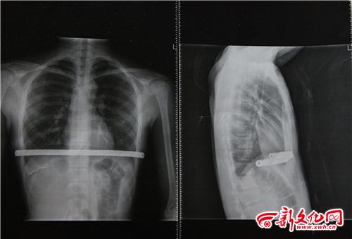長(zhǎng)春一初中生常莫名發(fā)燒40多度 病因仨月沒(méi)找到