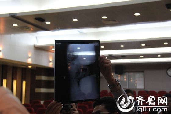 聊城針扎女嬰預計一周內(nèi)康復 醫(yī)生建議關(guān)注心理問題