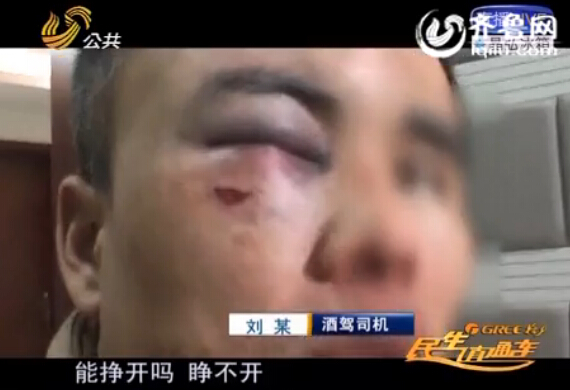 濟(jì)南：酒后斗毆被打滿臉傷痕 男子酒駕求救警察
