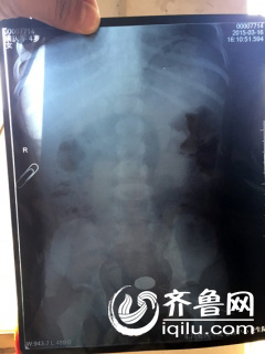 聊城：幼兒園四歲女童吞下硬幣 學(xué)生家長遭遇圍毆