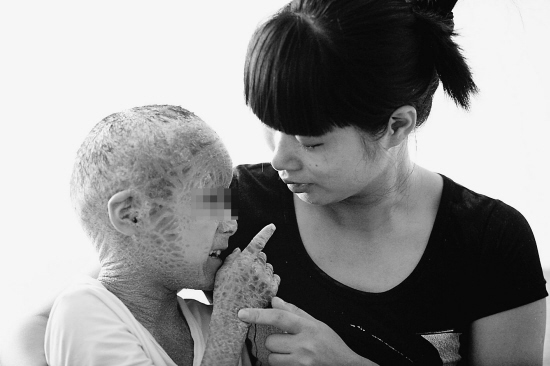 “樹皮娃娃”皮膚裂紋無數(shù) 不敢出門躲在家中(圖)