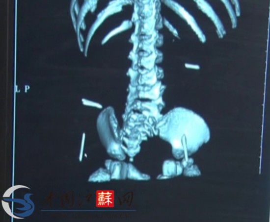 江蘇淮安女?huà)塍w內(nèi)取出4根縫衣針 或?yàn)槿藶樵?/></font></p>

<p align=
