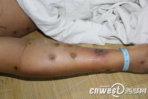 陜西安康數(shù)百人被毒蜂蜇傷 農(nóng)婦稻田邊被蜇200針