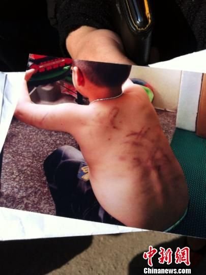 浙江4歲男童遭幼兒園老師暴打 遍體鱗傷