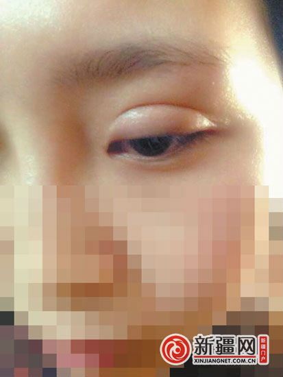烏魯木齊一女孩割雙眼皮后腫了9個(gè)月