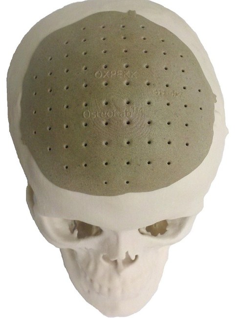 頭骨也能打??！美公司用3D打印技術(shù)造福移植患者