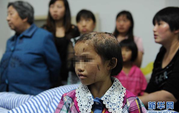 男子虐待親生女5年：開水燙頭、魚線縫嘴、跪碎玻璃(圖)