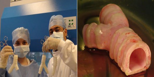 醫(yī)學界新突破：瑞典完成世界首例人造器官移植