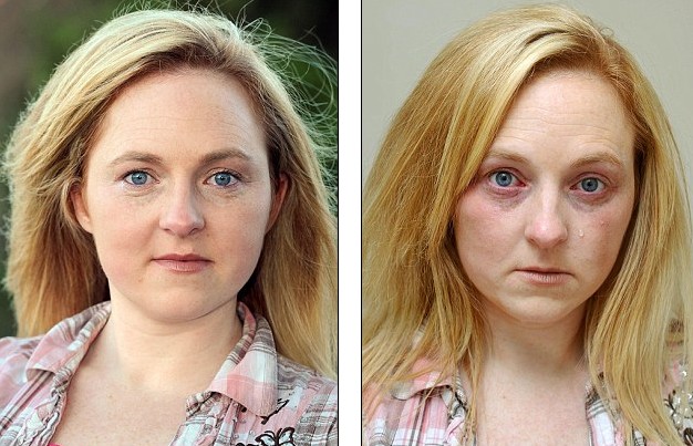 哭能致命！ 英國女子皮膚對水嚴(yán)重過敏不敢流淚