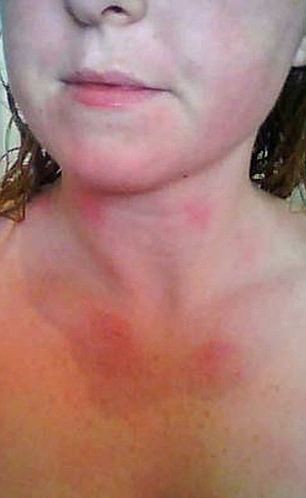 哭能致命！ 英國女子皮膚對水嚴(yán)重過敏不敢流淚