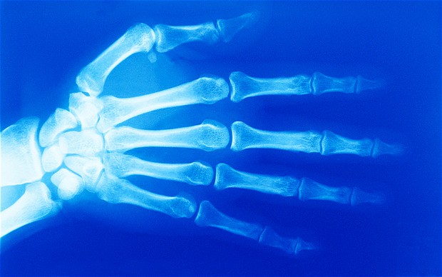 研究發(fā)現(xiàn)結(jié)核病菌能潛伏于患者骨髓中