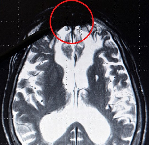 德國專家揭秘罪犯大腦結(jié)構(gòu)：邪惡黑影潛伏特定區(qū)域