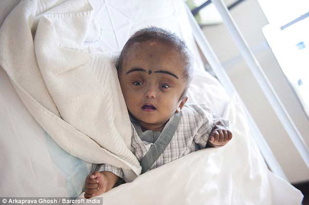 印度大頭女?huà)虢邮茴^骨矯正術(shù) 頭圍縮小到正常范圍