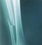 Something a bone will never say: Give me a break