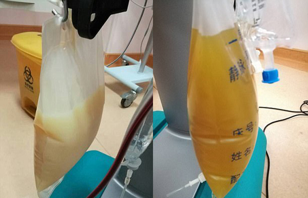中山男子腹痛緊急送醫(yī)搶救，檢出“牛奶血”！